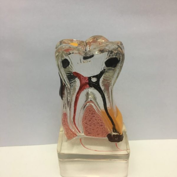 Modelo de Patologia de Caríes Dental
